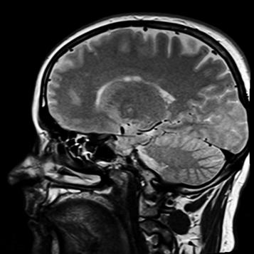 MRI of a human head